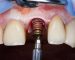Implantes dentales dental solutions