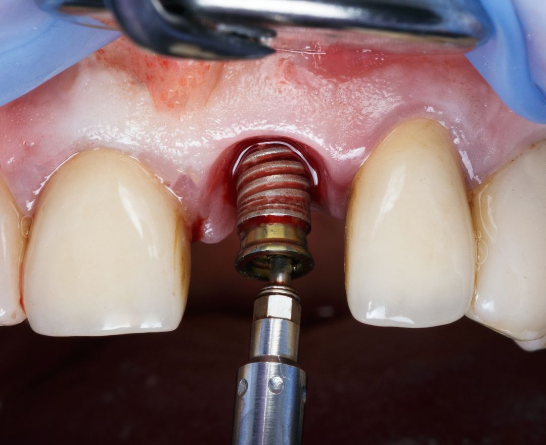 Implantes dentales dental solutions