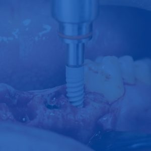 implantes dental solutions portada